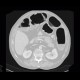Meteorism, distention of colon, reflex distention, vertebrogenic pain syndrome, compression fracture of vertebra: CT - Computed tomography